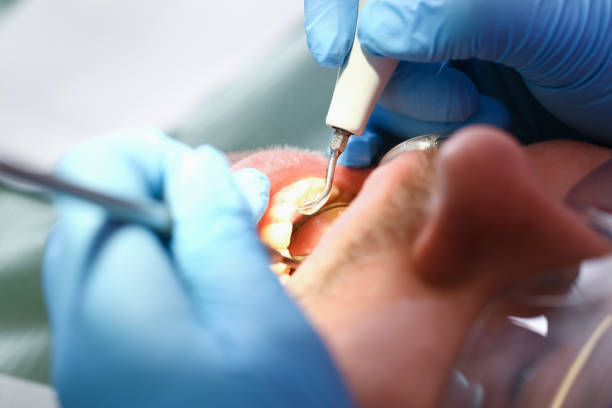 Best Emergency Tooth Extraction in Plymouth, CA
