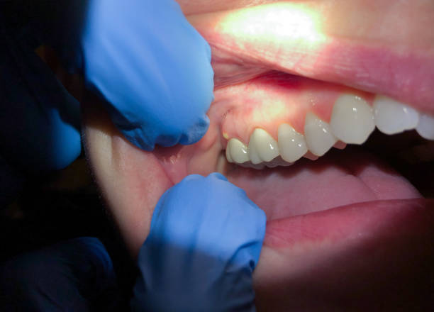 Best Emergency Denture Repair in Plymouth, CA